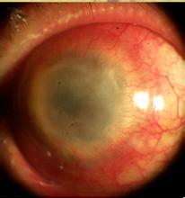 成都京研强直性脊柱炎研究院