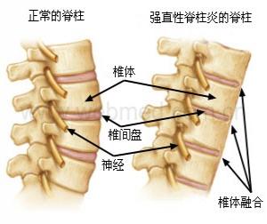 成都京研强直性脊柱炎研究院