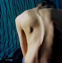 成都京研强直性脊柱炎研究院