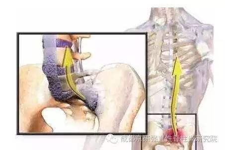 成都京研强直性脊柱炎研究院